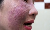 Sưng phù mặt, mụn kết tảng do làm trắng da cấp tốc