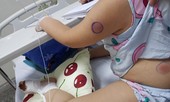 Gà mổ vào chân, bé gái bị nhiễm khuẩn “ăn thịt người”