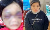 Điều tra vụ bé gái 6 tuổi ở Hải Dương bị mẹ bạo hành phải nhập viện