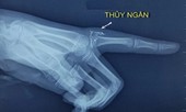 Bản tin 8H: Hi hữu bé gái nhiễm độc thủy ngân qua nhiệt kế