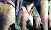 Hà Nội yêu cầu xác minh, xử lý vụ bé gái 12 tuổi bị bạo hành