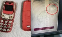 Một bệnh nhân vào viện vì đã nuốt cả chiếc điện thoại Nokia 3310, đến bác sĩ cũng choáng