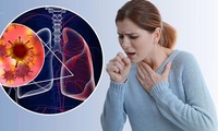 Những người cực dễ bị ung thư phổi ‘tấn công’ dù không hút thuốc