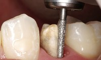 Mài răng một cách thô bạo là công đoạn không thể thiếu trong quá trình bọc răng sứ theo phương pháp cũ