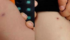 3 giáo viên mầm non bị tố dùng kim đâm trẻ