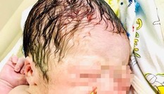 Hy hữu bé trai chào đời cùng vòng tránh thai của mẹ