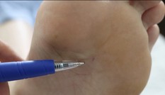Thiếu nữ suýt mất mạng vì một vết ong đốt
