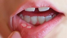 Mẹo chữa nhiệt miệng khỏi nhanh mà cực kỳ đơn giản