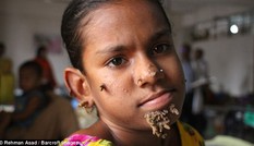 Kỳ lạ cô bé 'người cây' ở Bangladesh