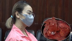 Cố nịt bụng vì sợ bị chê mập, không ngờ mang khối u tụy lớn nhất thế giới