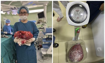 Khối u nặng 10 kg sau khi được phẫu thuật lấy ra khỏi ổ bụng bệnh nhân. Ảnh: BV cung cấp