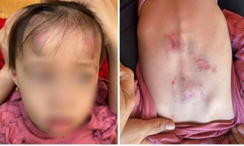 Những vết bầm tím của bé gái bị đánh ở lớp mầm non đăng tải trên mạng xã hội.