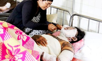 Chị A Sì Giá điều trị tại bệnh viện trong tình trạng bị bỏng nặng