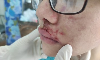 Tiêm filler tại thẩm mỹ viện có giá 3,5 triệu đồng/2 mũi, cô gái sưng phù khuôn mặt (ảnh: BVCC)