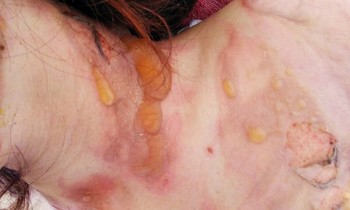 Vết thương trên người D.