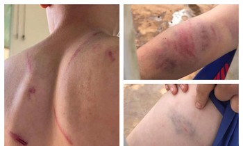 Mới nhất sức khỏe bé trai 9 tuổi bị bố ruột đánh đập dã man