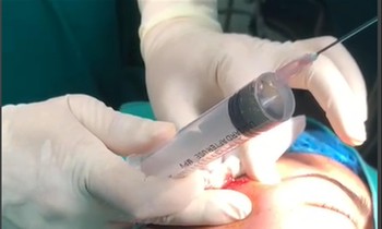 Bác sĩ xử lí ca tai biến sau tiêm filler vào thái dương