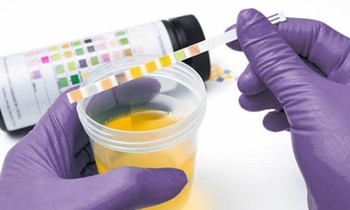 Màu sắc nước tiểu bất thường là cảnh báo của nhiều bệnh nguy hiểm