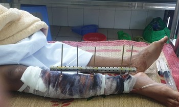 Nhóm côn đồ chém gục 3 ngư dân trên biển Hải Phòng