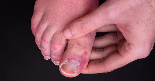 Nguyên nhân gây ra 'ngón chân COVID' là gì?