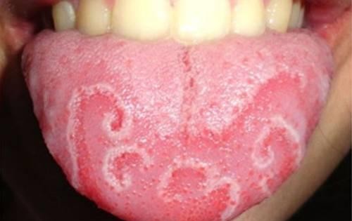 Những dấu hiệu bất thường ở lưỡi cảnh báo bệnh lý nguy hiểm