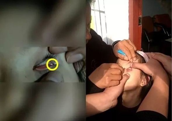 Trung Quốc: Bé gái suýt mù vì bị nhét giấy vào mắt Trung Quốc: Bé gái suýt mù vì bị nhét giấy vào mắt