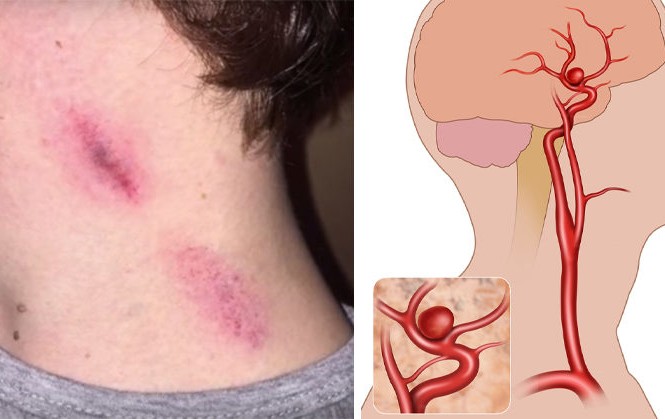 Cô dâu tử vong đêm tân hôn, bác sĩ cảnh báo 4 'điểm chết' trên cơ thể Động mạch cảnh là nơi rất nhạy cảm ở cổ