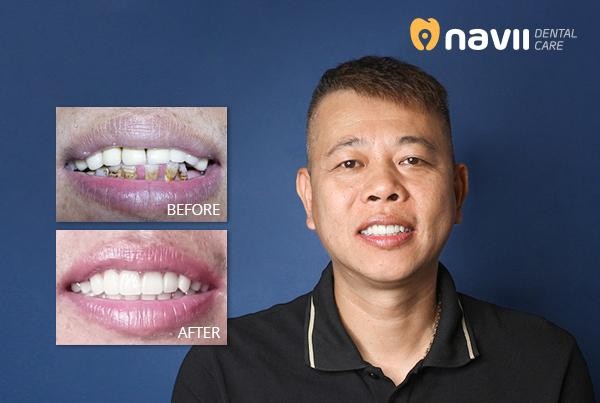 Implant ALL On 4 – Giải pháp an toàn tiết kiệm cho người bị mất răng toàn hàm Một ca cấy ghép Implant All on 4 mang lại vẻ đẹp hoàn hảo cho hàm răng tại nha khoa Navii