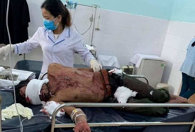 Tin mới vụ người đàn ông bị gấu rừng tấn công ở Quảng Nam Ông Hồ Văn Hội - Người bị gấu rừng tấn công hiện đang được điều trị tại Bệnh viện Đa khoa Quảng Nam. Ảnh T. C