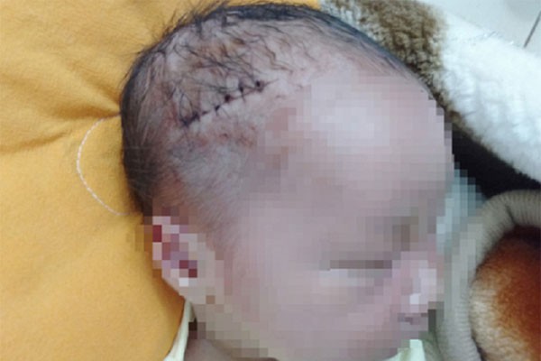 Bé trai mới sinh phải khâu 6 mũi do bác sĩ rạch trúng đầu khi mổ Bé trai mới sinh phải khâu 6 mũi do bác sĩ rạch trúng đầu khi mổ