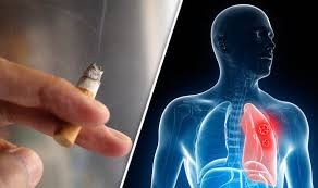 Nguyên nhân và những triệu chứng sớm của ung thư phổi Ảnh minh họa: Daily Express