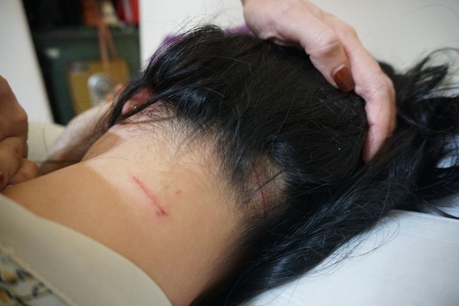 Khởi tố, bắt tạm giam cựu cán bộ công an đánh vợ cũ dã man Chị Trang được đưa đi giám định với tỷ lệ thương tật 12%.