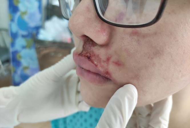 TPHCM: Cô gái trẻ sưng phù mặt khi tiêm filler làm đẹp Tiêm filler tại thẩm mỹ viện có giá 3,5 triệu đồng/2 mũi, cô gái sưng phù khuôn mặt (ảnh: BVCC)