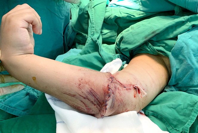 Sau tai nạn, bé trai 8 tuổi đứt lìa cánh tay Cánh tay sau khi được Bệnh viện Nhi đồng 2 nối thành công