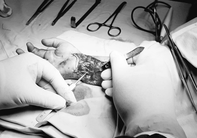Đang tắm gặp tai nạn bất ngờ, bé trai 6 tuổi đứt gần lìa bàn tay Đang tắm gặp tai nạn bất ngờ, bé trai 6 tuổi đứt gần lìa bàn tay