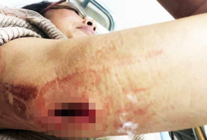 Nữ chủ quán cà phê bị nhóm đòi nợ thuê chém gục Nạn nhân bị thương, phải vào bệnh viện cấp cứu