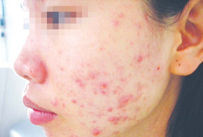 Sát Tết, lại khổ vì mỹ phẩm giả Một nạn nhân của dị ứng mỹ phẩm