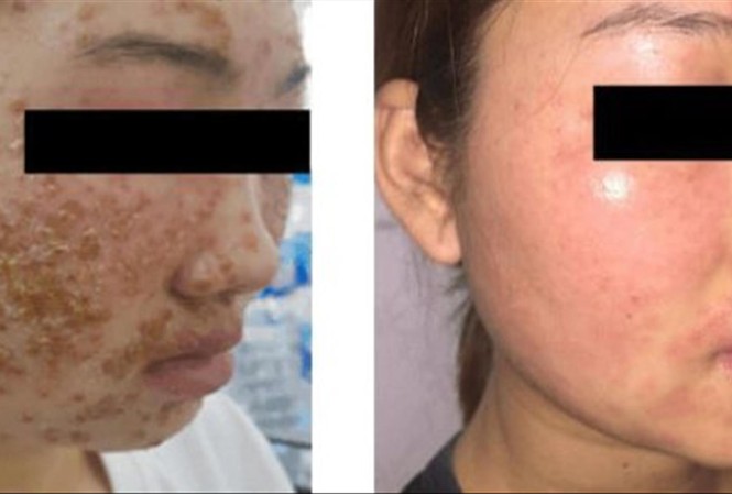 Gặp họa vì dùng bột rửa mặt mua online Bệnh nhân trước và sau 5 ngày điều trị
