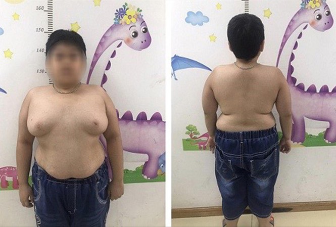Báo động lạm dụng corticoid gây hậu quả nặng nề Bé trai 13 tuổi tăng cân mất kiểm soát sau khi lạm dụng thuốc corticoid Ảnh: T.Hà
