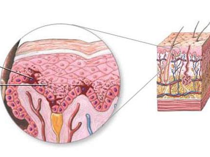 Tẩy vết sẹo thâm, dùng thuốc gì? Tẩy vết sẹo thâm, dùng thuốc gì?