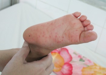 Thanh niên hưởng ứng phòng chống dịch tay chân miệng Thanh niên hưởng ứng phòng chống dịch tay chân miệng