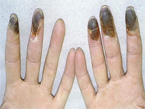 Hút nhiều thuốc lá có thể bị cụt chân tay Hút nhiều thuốc lá có thể bị cụt chân tay