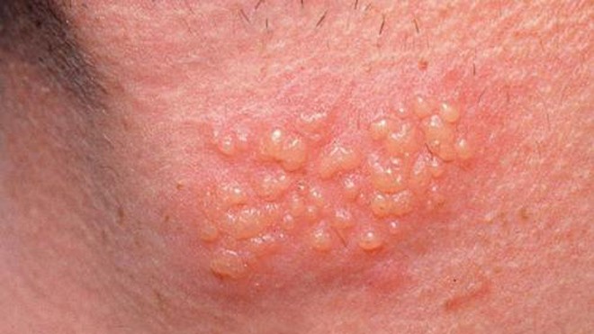 5 bài thuốc tự nhiên chữa mụn rộp tại nhà Ảnh minh họa