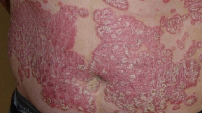 Tác dụng phụ kinh hoàng của thần dược corticoid Hình ảnh da bị tổn thương do tác dụng phụ của corticoid