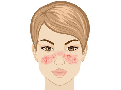 12 dấu hiệu cảnh báo bệnh lupus ban đỏ Vết phát ban hình con bướm cảnh báo nguy cơ mắc bệnh lupus. Ảnh: Pinterest.