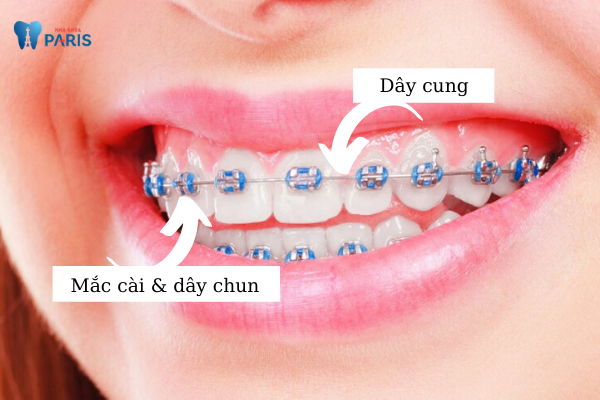 Nên lựa chọn niềng răng mắc cài kim loại thường hay tự buộc? Niềng răng mắc cài kim loại thường