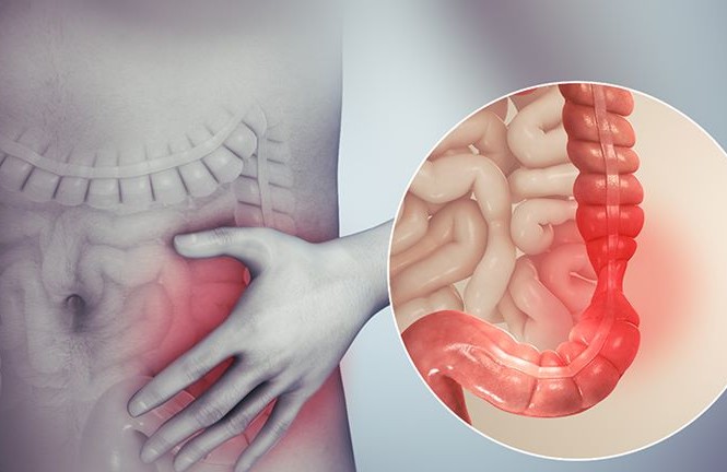Cách giảm đau đại tràng nhanh, hiệu quả của người Nhật Cách giảm đau đại tràng nhanh