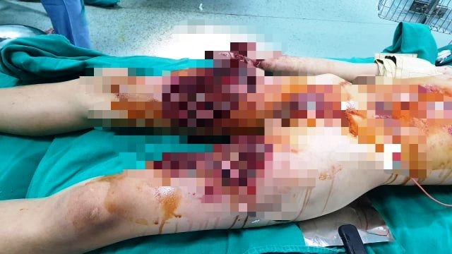 Học sinh bị nát bàn tay do làm pháo Học sinh bị nát bàn tay do làm pháo