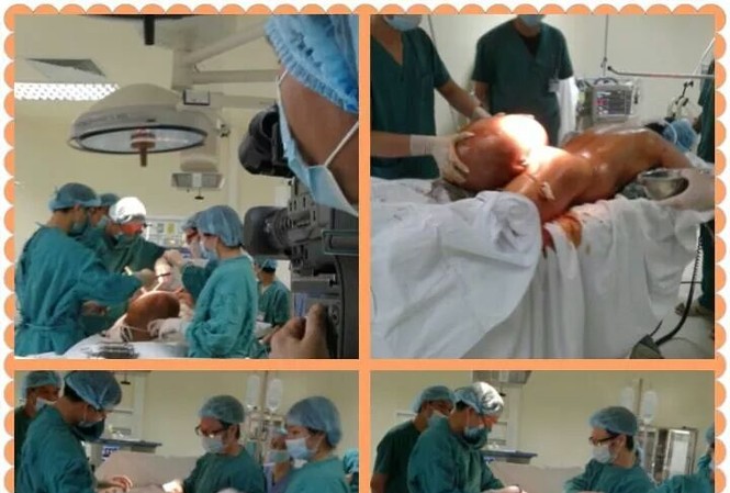 Cắt thành công khối u khổng lồ nặng 12 kg Ca mổ khối u khủng lồ cho bệnh nhân Quý (Ảnh: BV Ung bướu Hà Nội)