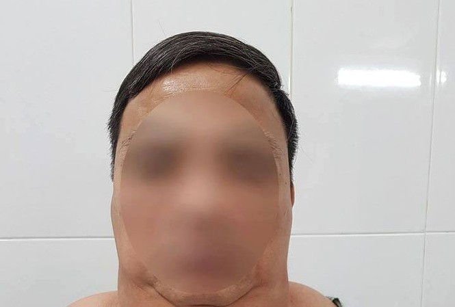 Bợm nhậu cổ phình to như bướu lạc đà vì 'xơi' 1 lít rượu mỗi ngày Bệnh nhân với khối u khi chưa được phẫu thuật. Ảnh: Bệnh viện Ung bướu Hà Nội cung cấp